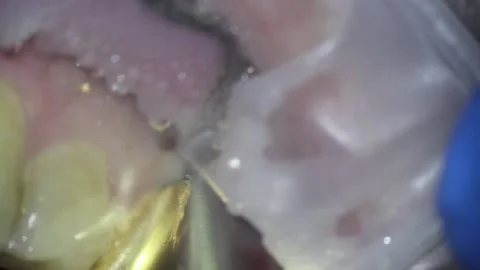 Dentistry. video filming under a microscope. removal of a gold crown on a tooth Stock Footage 162040801