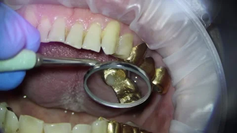 Dentistry. video filming under a microscope. examination of the golden bridge of Stock Footage 162040831