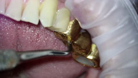 Dentistry. video filming under a microscope. examination of the golden bridge of Stock Footage 162040891