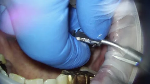 Dentistry. video filming under a microscope. removal of a gold crown on a tooth Stock Footage 162040940