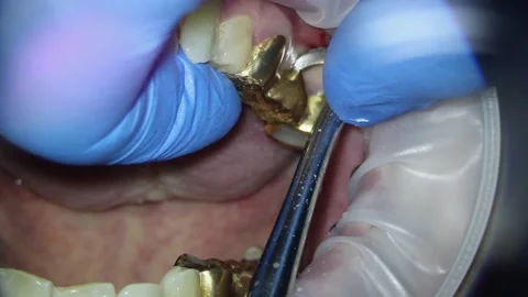 Dentistry. video filming under a microscope. removal of the gold bridge of the Stock Footage 162041021