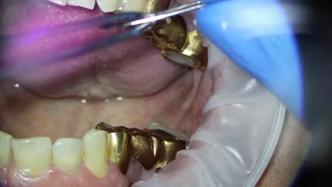 Dentistry. video filming under a microscope. removal of a gold crown on a tooth Vidéo 162041052