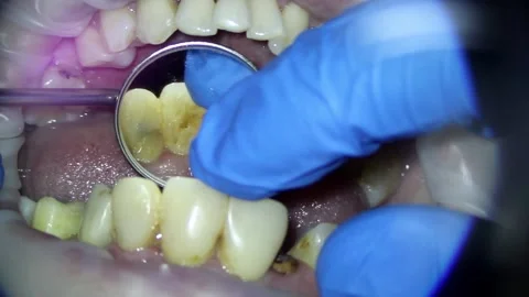 Dentistry. video filming under a microscope. diagnosis of a root fracture of Stock Footage 162041123