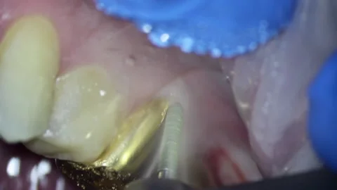 Dentistry. video filming under a microscope. removal of a gold crown on a tooth Vidéo 162041172