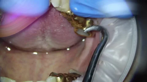 Dentistry. video filming under a microscope. removal of the gold bridge of the Stock Footage 162041241