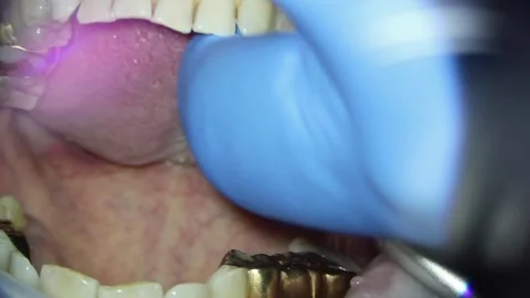 Dentistry. video filming under a microscope. removal of a gold crown on a tooth Stock Footage 162041281