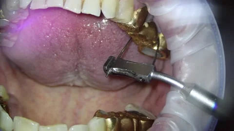 Dentistry. video filming under a microscope. removal of a gold crown on a tooth Stock Footage 162041320