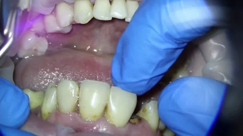 Dentistry. video filming under a microscope. diagnosis of a root fracture of Stock Footage 162041453