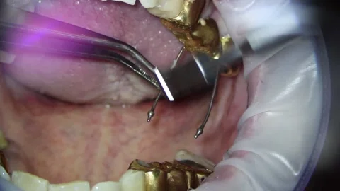 Dentistry. video filming under a microscope. removal of a gold crown on a tooth Stock Footage 162041567