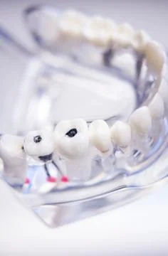 Dentists dental teeth model Foto stock