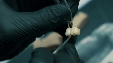 Denture, artificial tooth, denture, hands working on the denture, artificial Stock Footage 147673423