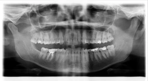 Denture jaw teeth x-ray of young woman Stock Illustration