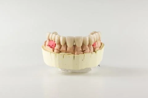 The denture made of ceramics located on plaster model Stock Photos