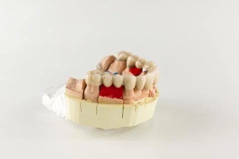 The denture made of ceramics located on plaster model Stock Photos