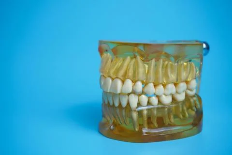 Dentures on a blue background.Upper and lower jaws with false teeth. Dentur.. Stock Photos