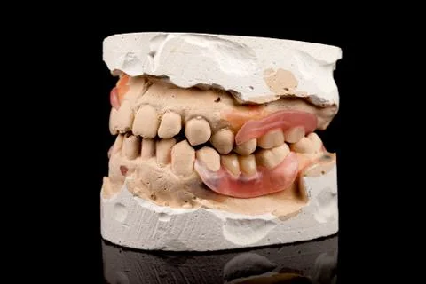 Dentures on a plaster cast Foto stock