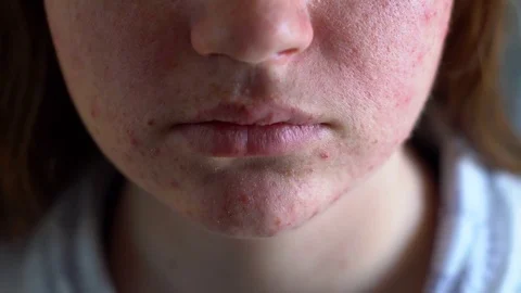 Depressed girl with acne problem, close-up shot Stock Footage 73755047