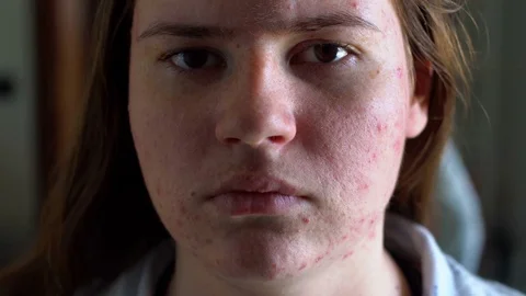 Depressed girl with acne problem Stock Footage 73755107