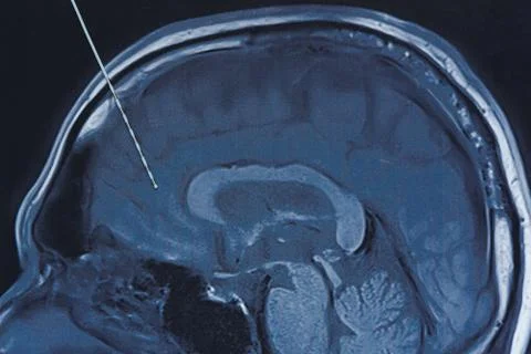 Depth electrode on brain MRI imaging. Stock Photos
