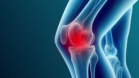 In-Depth Knee Arthritis Animated Visualization Stock Footage 317144641