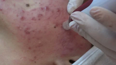 DermaPen Skin Rejuvenation Stock Footage 58926052
