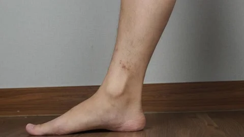 Dermatitis on feet ankle condition with hand itching action Stock Footage 129801433