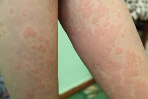 Dermatitis Stock-Fotos