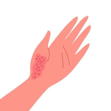 Dermatitis on the skin of a human hand Stock Illustration
