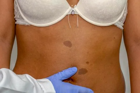 Dermatologist checking the benign moles, Stock Photos