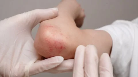Dermatologist examines reddened, itchy areas with rash on childs elbow, close-up Stock Footage 323071063