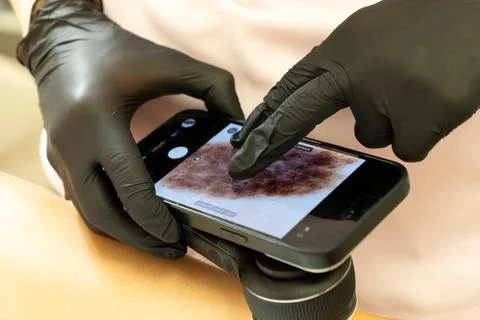 Dermatologist Examining a Mole Using a Dermatoscope Фото