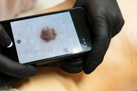 Dermatologist Examining a Mole Using a Dermatoscope Stockfoto's