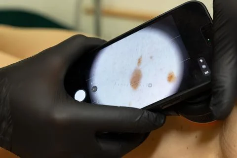 Dermatologist Examining a Mole Using a Dermatoscope 库存照片