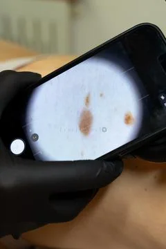 Dermatologist Examining a Mole Using a Dermatoscope Photos