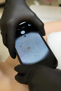 Dermatologist Examining a Mole Using a Dermatoscope Stockfoto's
