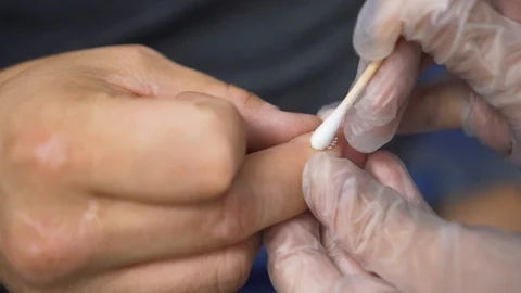 Dermatologist makes a procedure of removing warts and dark spots by nitrogen. Stock Footage 121624962