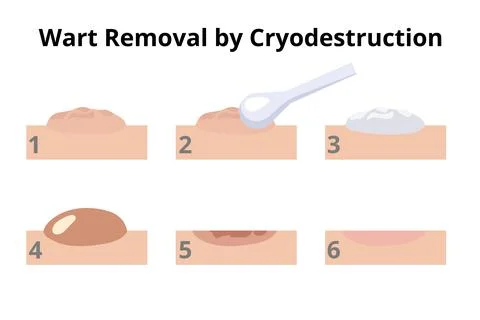 Dermatologist removing wart using cryodestruction procedure in six steps Stock Illustration