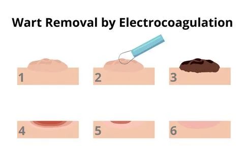 Dermatologist removing wart using electrocoagulation in six steps Stock Illustration