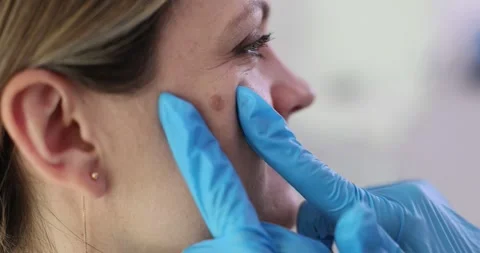 Dermatologist squeezes pimple on patient face during skin care Stock Footage 314107226