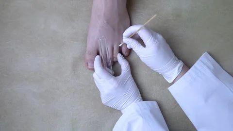 Dermatologist using a cotton swab and test tube to take a swab sample from a pat Stock Footage 305545818