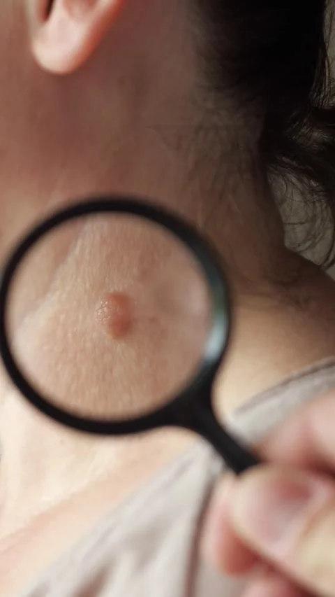 Dermatologist using a magnifying glass to examine a mole on a patients neck for Video stock 341677622