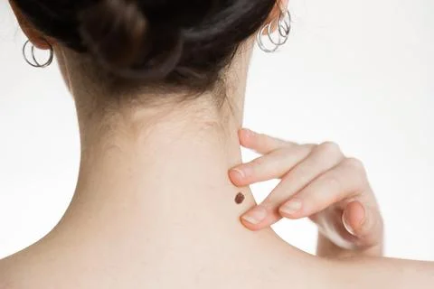Dermatology. Close-up of a woman's neck. The hand shows a large mole. The c.. Stock Photos
