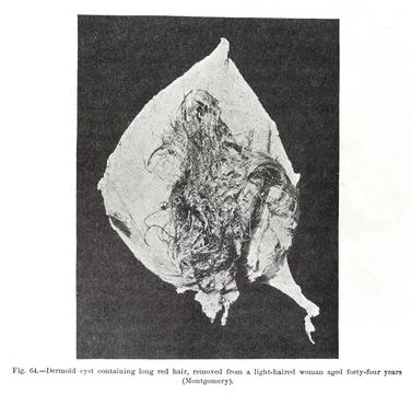 Dermoid cyst containing long red hair, removed from a light-haired woman ag.. Stock Illustration