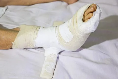 Derotational Cast Boot on an Elderly Womans Leg for a Femur Fracture 스톡 사진