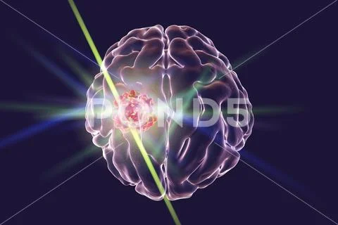 Destruction of brain tumor Stock Illustration
