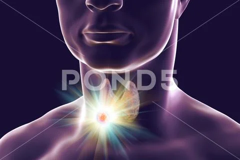 Destruction of thyroid tumor Stock Illustration