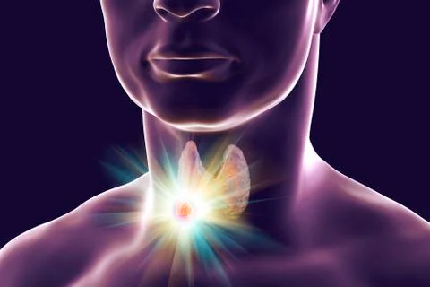 Destruction of thyroid tumor Stock Illustration