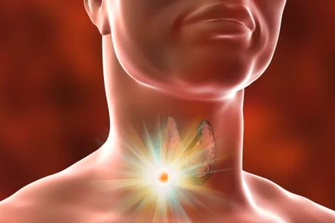 Destruction of thyroid tumor Stock Illustration