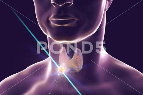 Destruction of thyroid tumor Stock Illustration