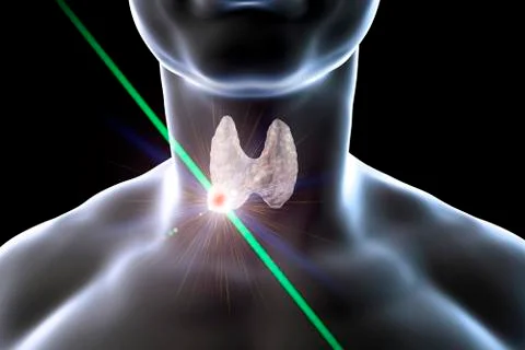 Destruction of thyroid tumor Stock Illustration